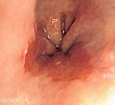 Endoscopic image of Barretts esophagus, which is the area of red mucosa projecting like a tongue. Biopsies showed intestinal metaplasia.