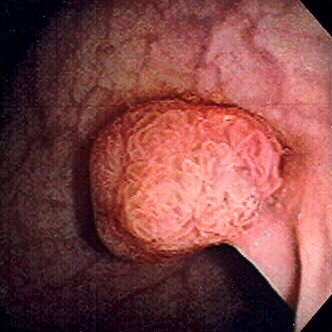 Polyp of sigmoid colon as revealed by colonoscopy. Approximately 1 cm in diameter.